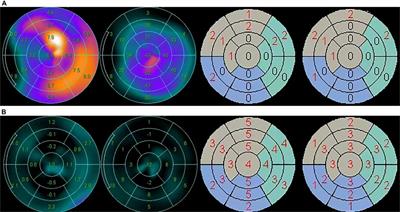 Prognostic value of summed motion score assessed by gated SPECT myocardial perfusion imaging in patients with dilated cardiomyopathy